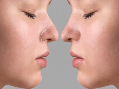 Refine Your Nose Without Surgery: Non-Surgical Rhinoplasty at My Aesthetics Clinic in Saltdean