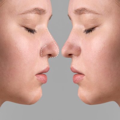 Refine Your Nose Without Surgery: Non-Surgical Rhinoplasty at My Aesthetics Clinic in Saltdean